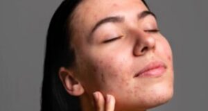 Seis dicas de skincare para pele acneica